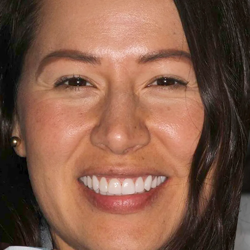 Before and after close-up images of a middle-aged woman's smile transformation using ultra-thin veneers. The first image shows her natural teeth with slight discoloration and minor alignment issues.