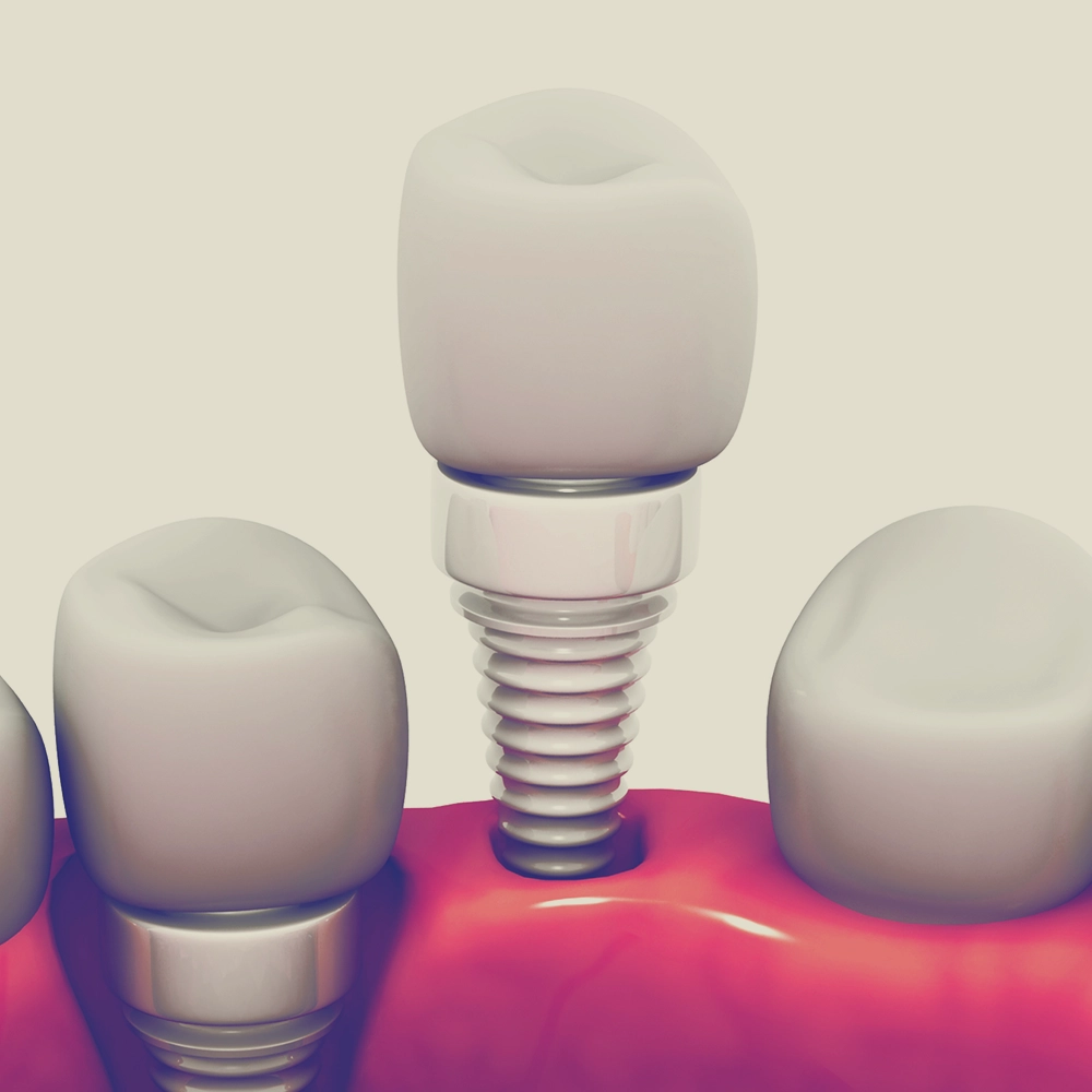 A 3D model showing a single dental implant with a crown attached, positioned between natural teeth, highlighting the integration of the implant into the gum tissue.