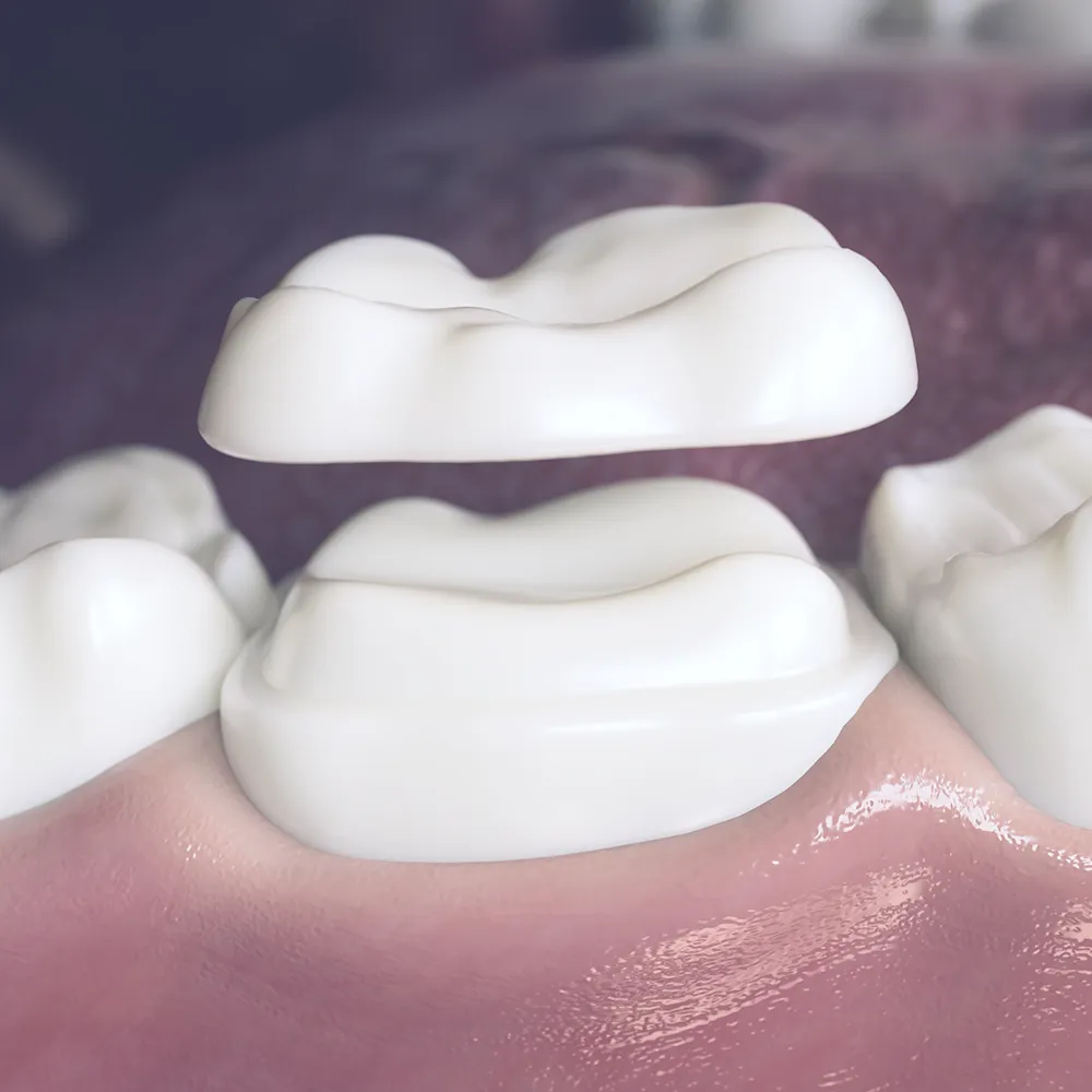 Close-up view of two types of biomimetic dental restorations laid over gums, showing realistic tooth texture and color.