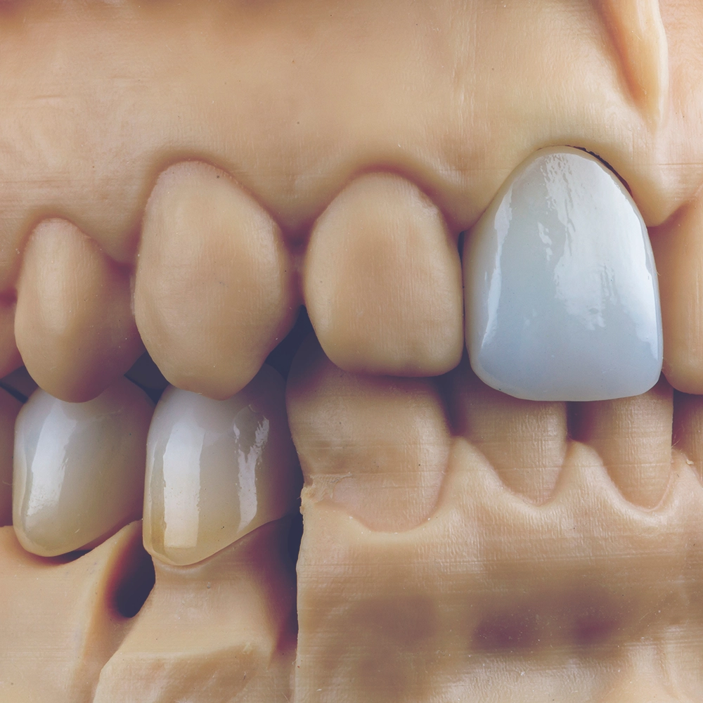 A detailed model showing a singular dental veneer on a set of gums and teeth, emphasizing the veneer's fit and finish.