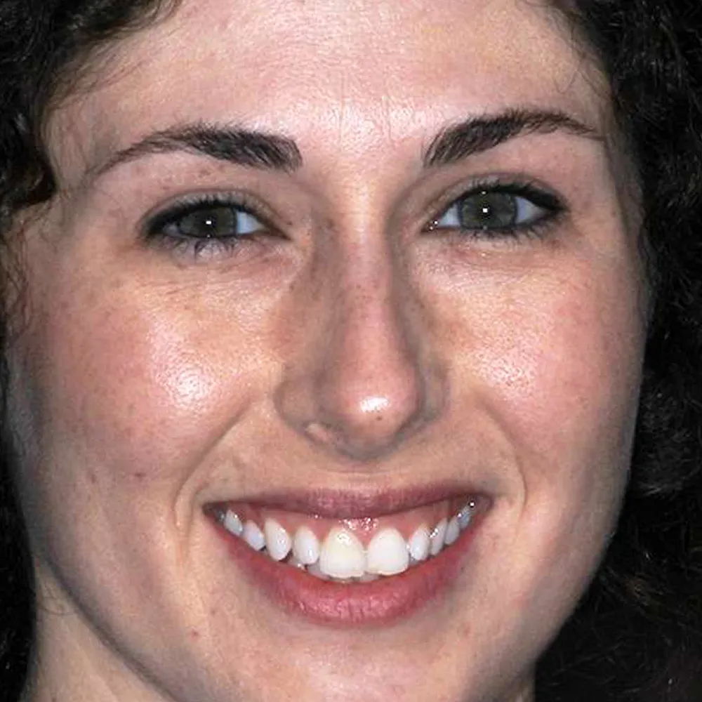 Before and after close-up images of a young woman's smile showing the results of ultra-thin veneers. The first image shows her natural teeth, which are slightly uneven and have minor discolorations. The second image displays her enhanced smile with perfectly aligned, bright white teeth, significantly improving her overall facial aesthetics.