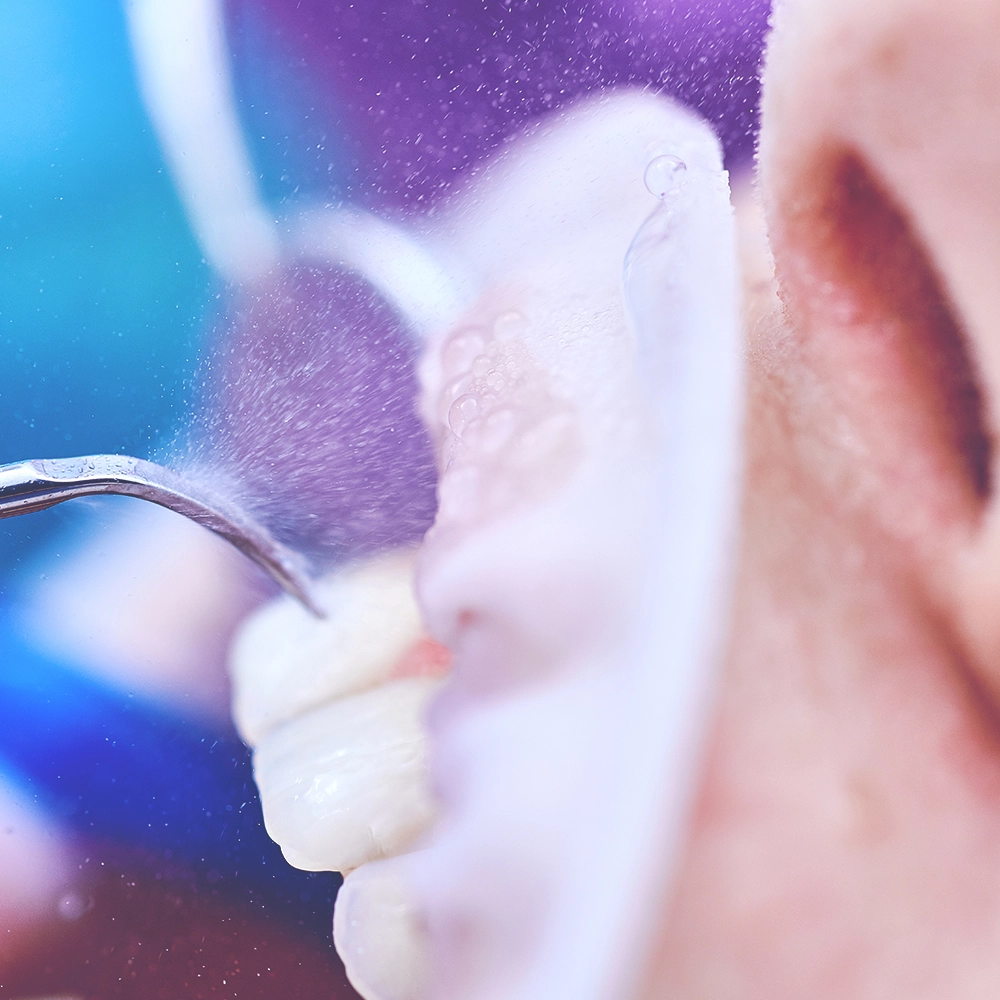 Close-up of a dental procedure involving a mouth guard, showing a detailed view of the dental work in progress with water spray visible.