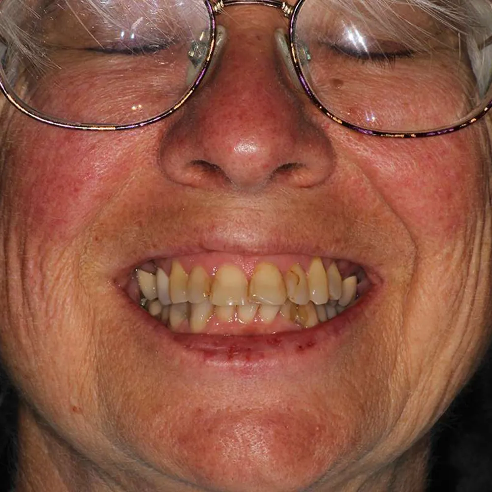 Before and after close-up images of an elderly woman's smile transformation with ultra-thin veneers. The first image shows her teeth with noticeable discoloration and uneven alignment. The second image displays her smile after treatment, featuring bright, perfectly aligned white teeth, significantly enhancing her overall appearance.