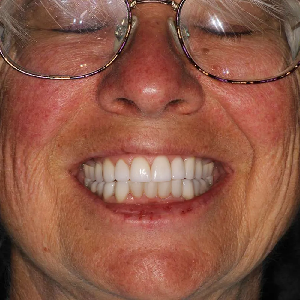 Before and after close-up images of an elderly woman's smile transformation with ultra-thin veneers. The first image shows her natural teeth with noticeable discoloration and uneven alignment. The second image displays her smile after treatment, featuring bright, perfectly aligned white teeth, significantly enhancing her overall appearance.