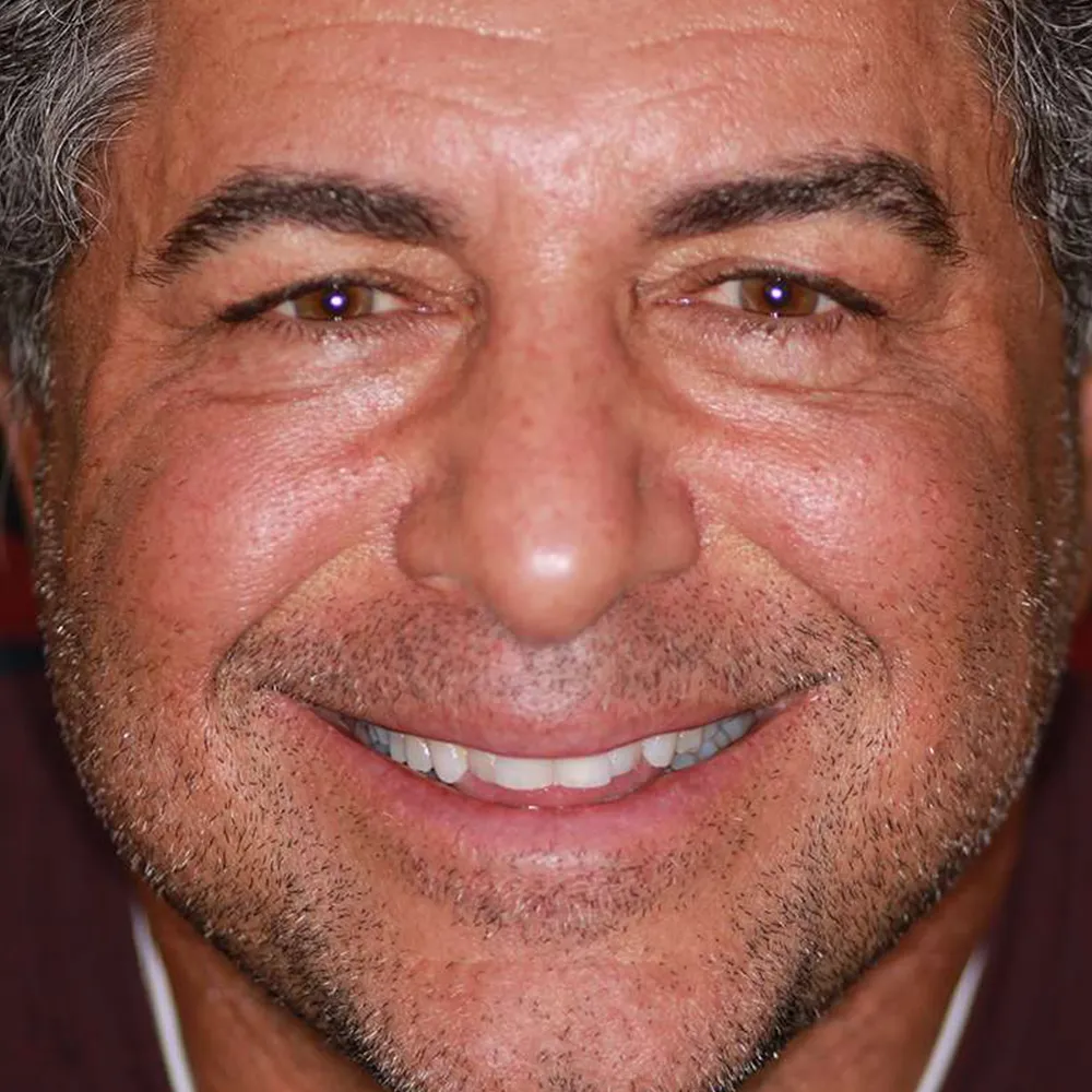 Before and after close-up images of a middle-aged man's smile transformation using ultra-thin veneers. The first image shows his smile with slightly uneven and discolored teeth before treatment. The second image displays his enhanced smile with perfectly aligned, bright white teeth achieved through the application of ultra-thin veneers.