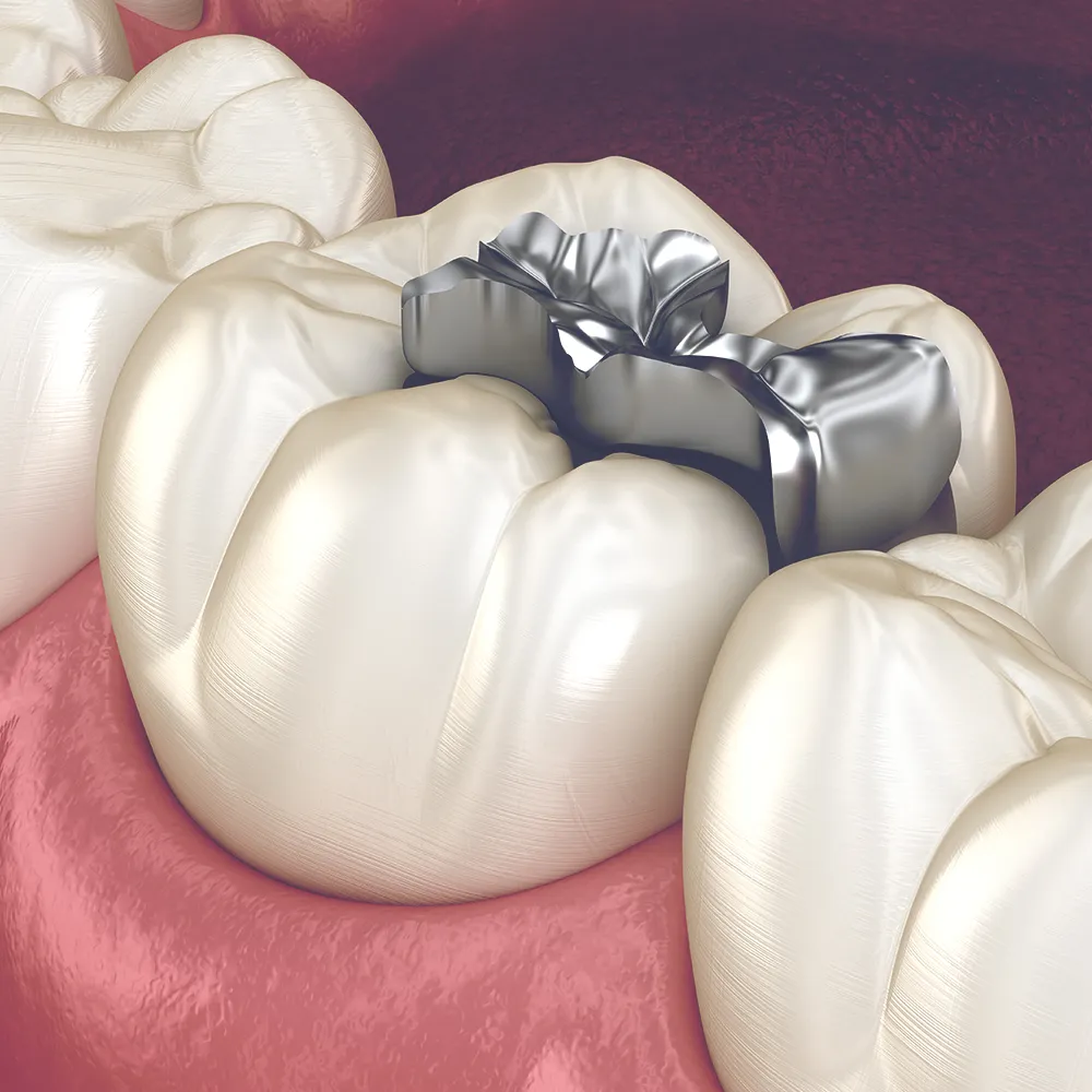 A detailed image showcasing the removal of a silver amalgam filling from a tooth. The image focuses on the dental instrument applying pressure to the metallic filling.