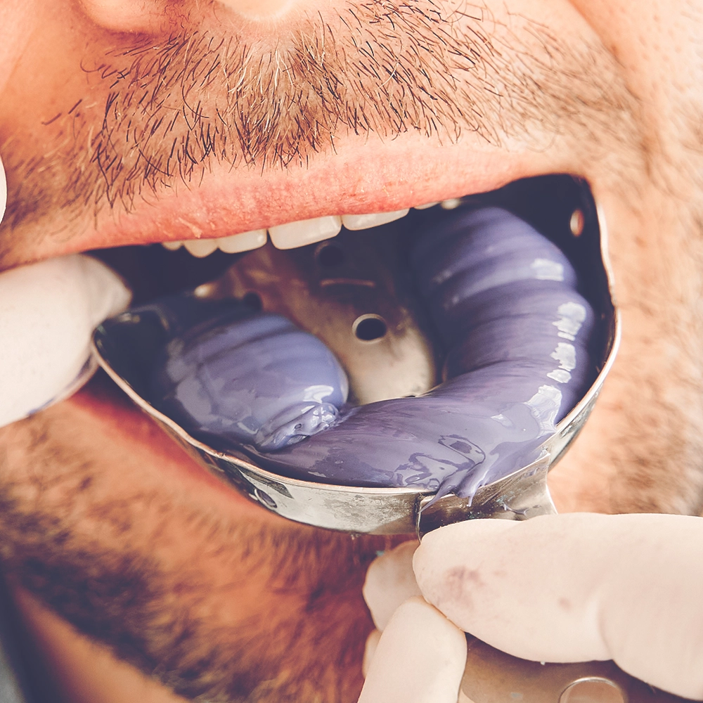 A close-up image of a dental professional applying a purple impression material to a patient's lower teeth, capturing the essential step of mold taking for dental restoration.