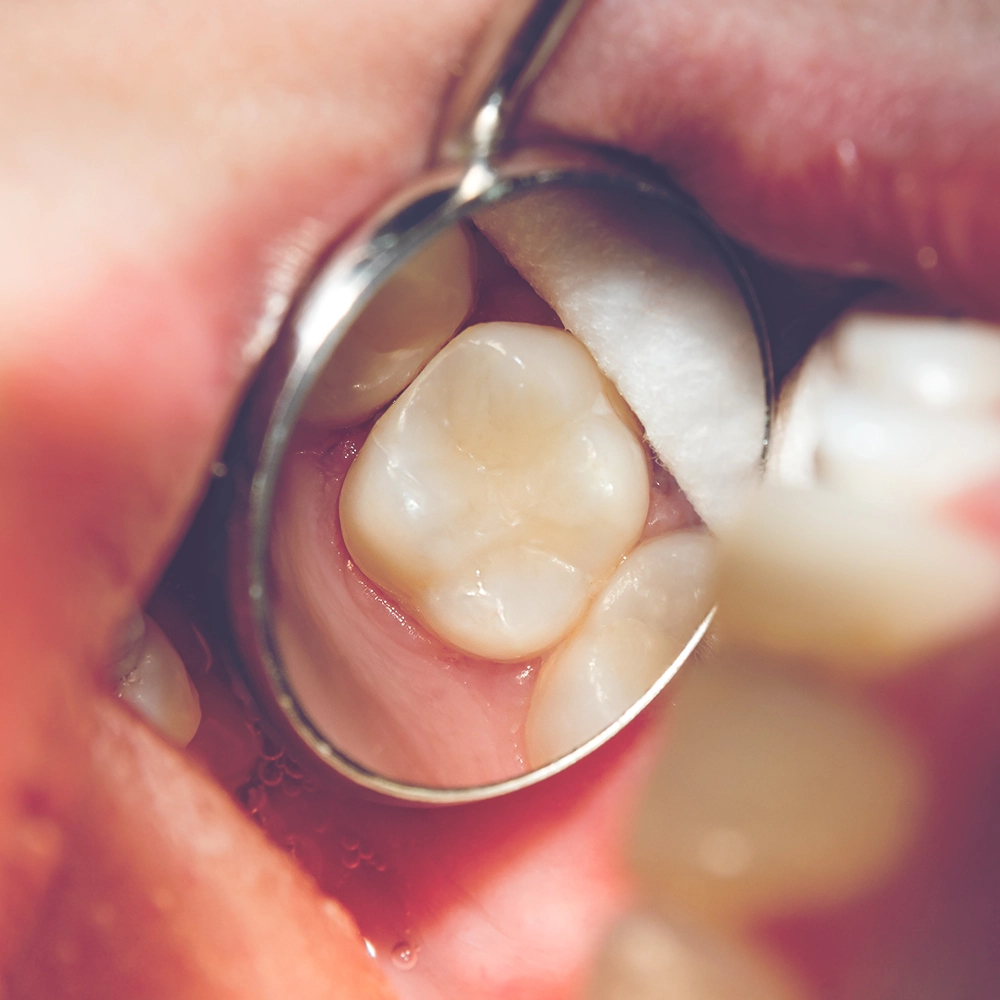 An image captured through a dental mirror showing a healthy molar that has just undergone a filling removal, highlighting the tooth's restored condition.