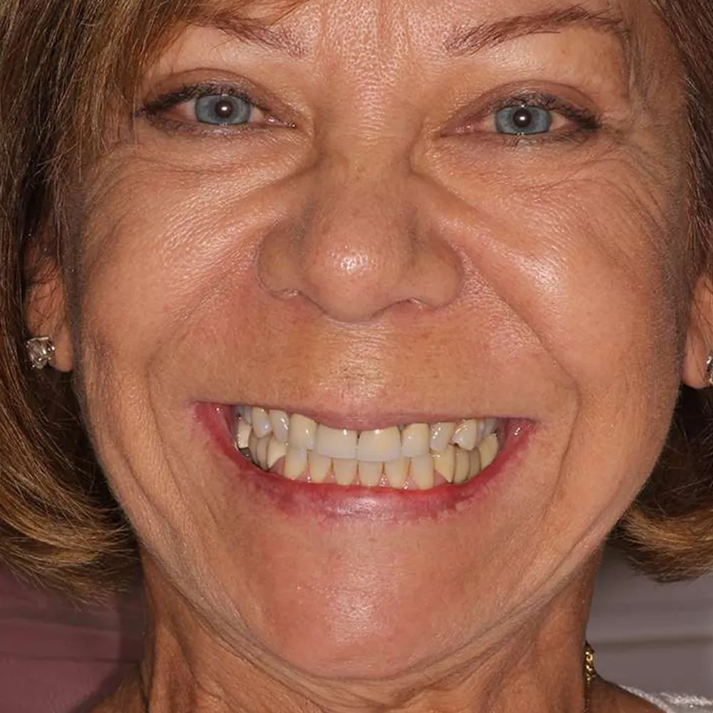 Before and after close-up images of a middle-aged woman's smile transformation with ultra-thin veneers. The first image shows her teeth before treatment, and the second image displays her bright, evenly aligned teeth after the cosmetic dental procedure.