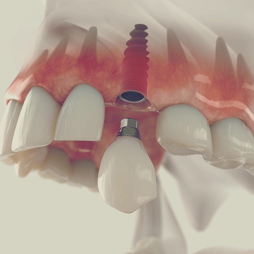 Close-up 3D visualization of a single tooth being placed onto a dental implant in the upper jaw, with the implant screw clearly visible, depicting the step-by-step process of implant placement.