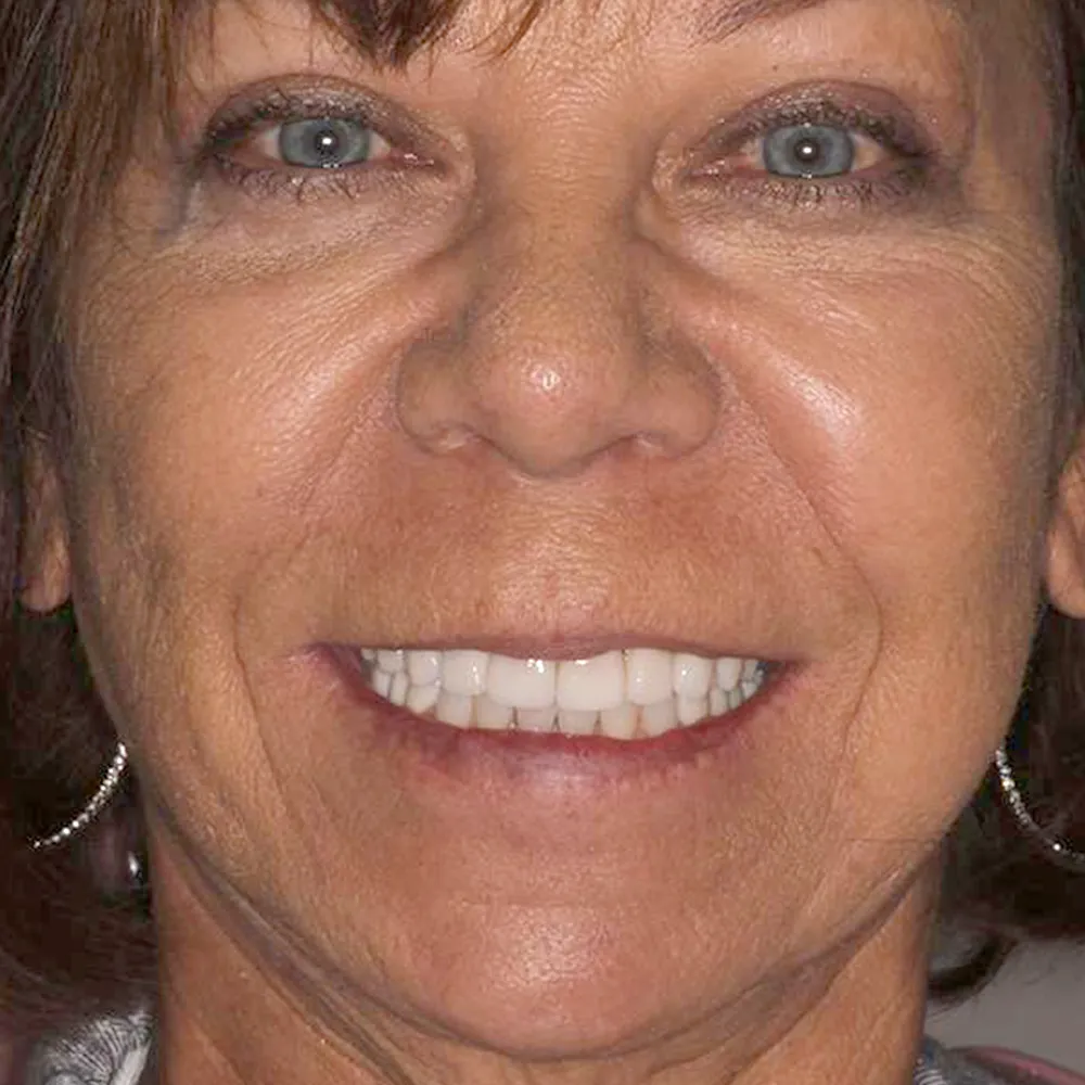 Before and after close-up images of a middle-aged woman's smile transformation with ultra-thin veneers. The first image shows her teeth before treatment, and the second image displays her bright, evenly aligned teeth after the cosmetic dental procedure.