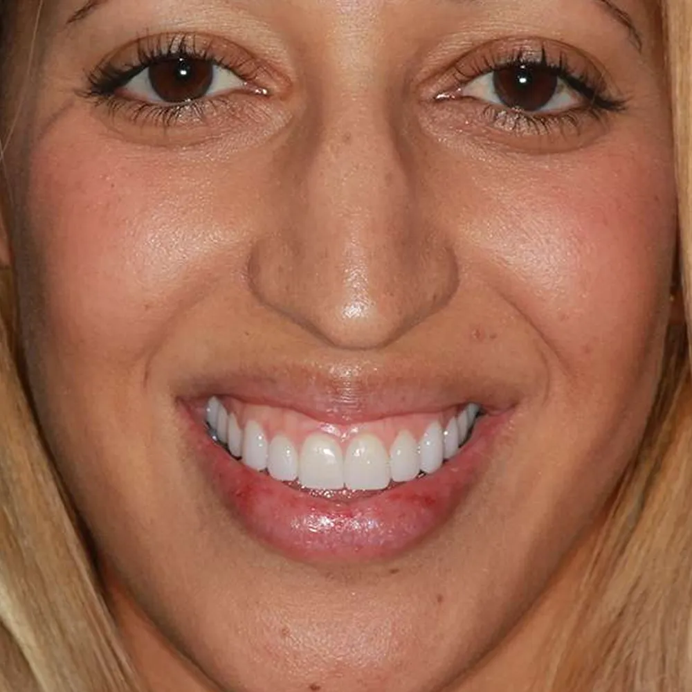 Before and after close-up images of a young woman's smile transformation using ultra-thin veneers. The first image shows her smile with teeth that are slightly uneven and discolored. The second image displays her smile after treatment, featuring bright, perfectly aligned white teeth that enhance her youthful appearance.