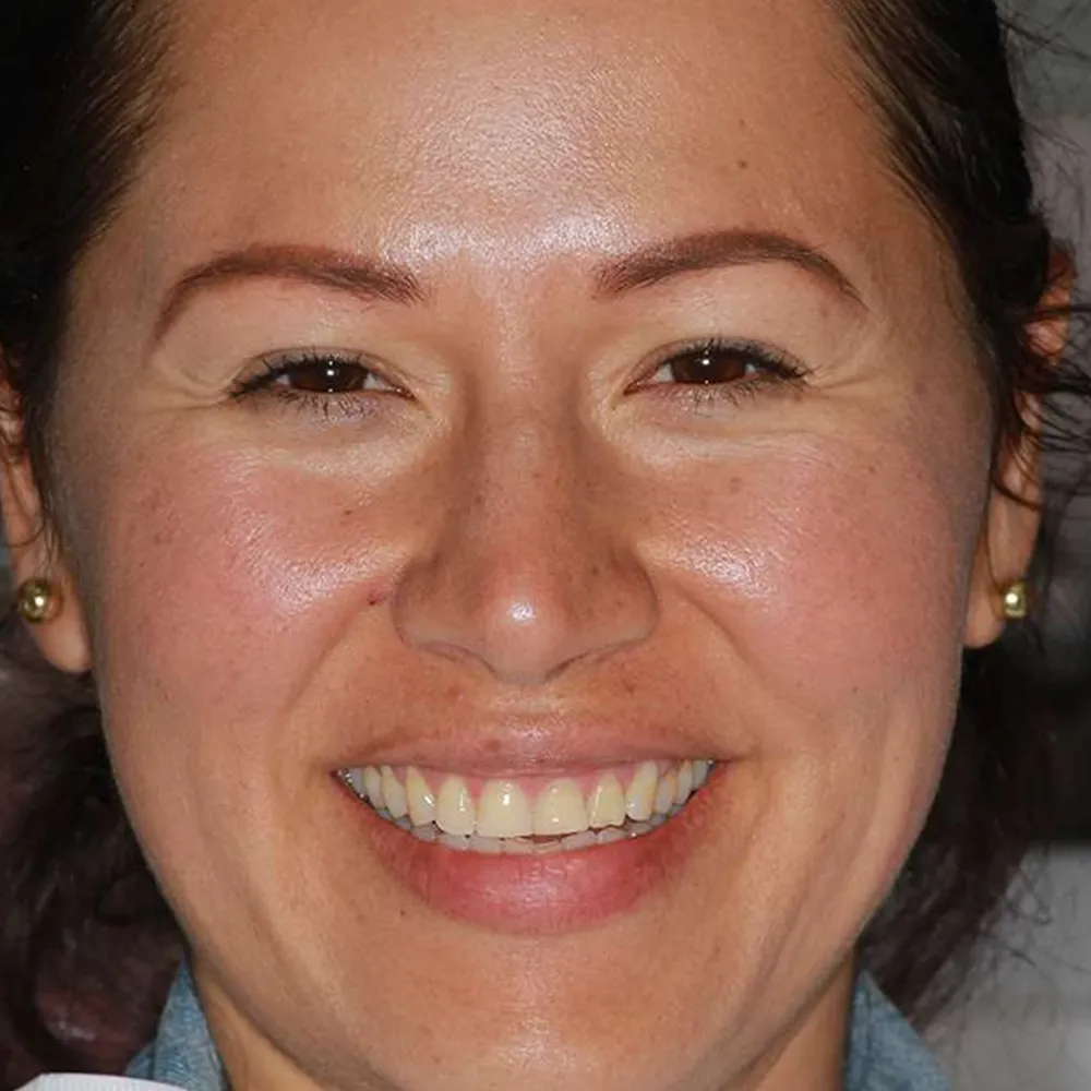 Before and after close-up images of a middle-aged woman's smile transformation using ultra-thin veneers. The first image shows her teeth with slight discoloration and minor alignment issues.