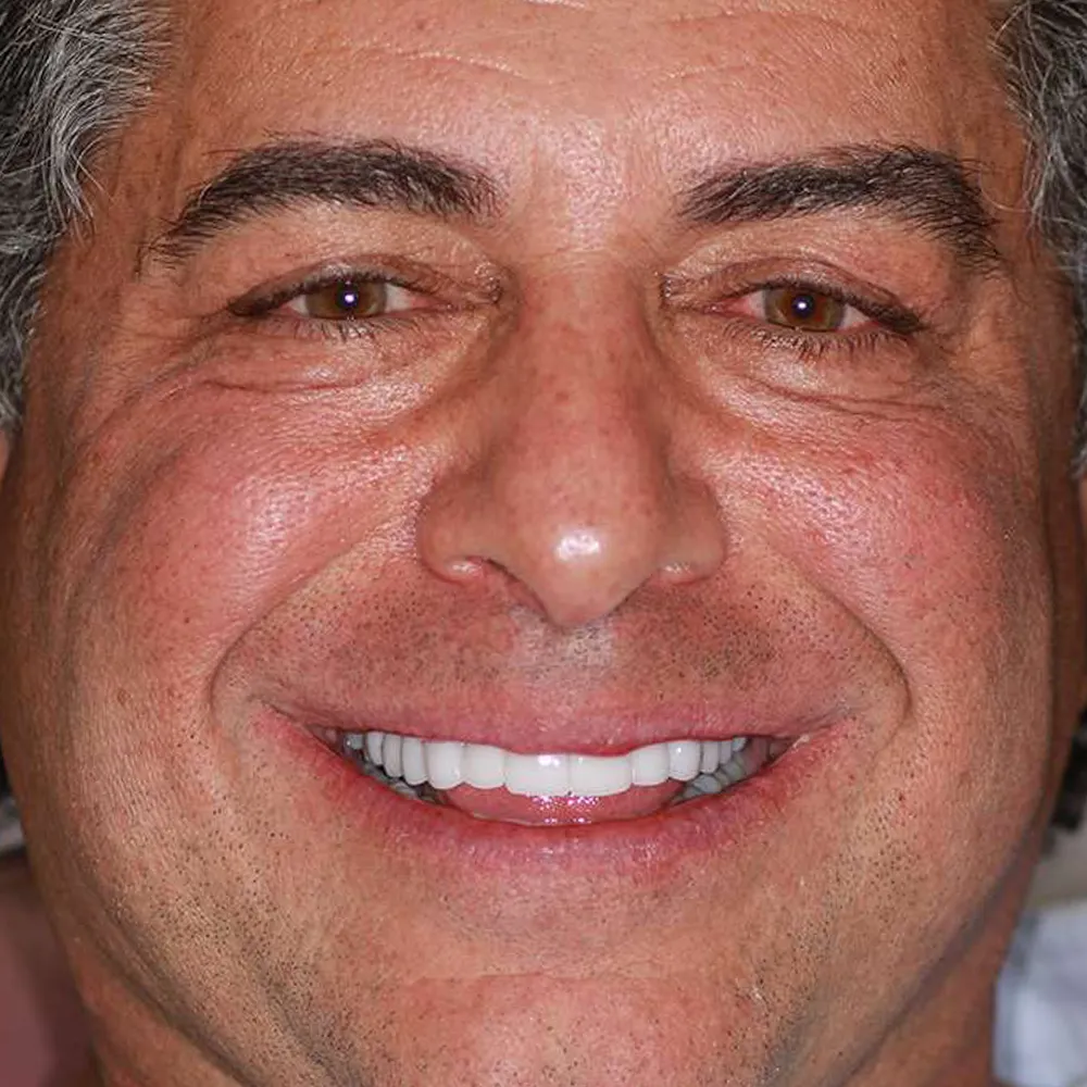 Before and after close-up images of a middle-aged man's smile transformation using ultra-thin veneers. The first image shows his smile with slightly uneven and discolored teeth before treatment. The second image displays his enhanced smile with perfectly aligned, bright white teeth achieved through the application of ultra-thin veneers.