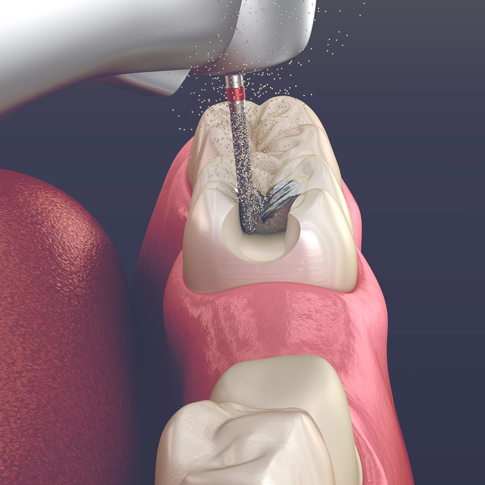 A graphic representation of a dental drill removing an old filling from a tooth, with particles depicted as flying away from the drill site.