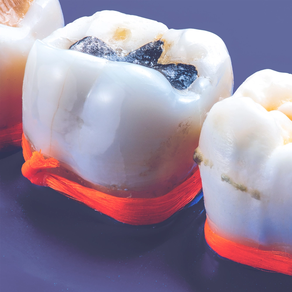 An up-close image displaying a collection of extracted teeth, each showcasing mercury fillings and signs of dental treatment.