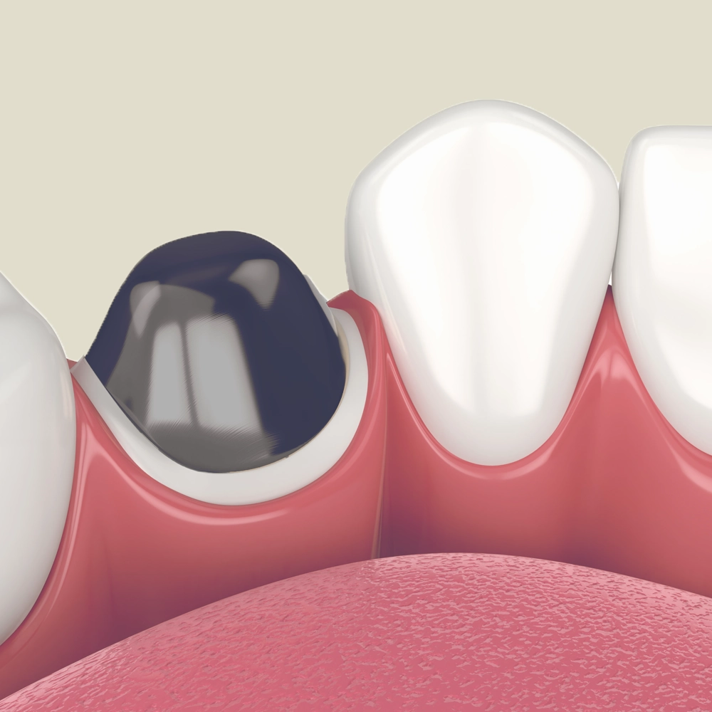 A highly detailed 3D rendering of a dental crown being placed over a prepared tooth, with emphasis on the precise fit and finish of the crown.