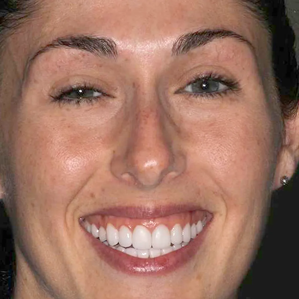 Before and after close-up images of a young woman's smile showing the results of ultra-thin veneers. The first image shows her teeth, which are slightly uneven and have minor discolorations. The second image displays her enhanced smile with perfectly aligned, bright white teeth, significantly improving her overall facial aesthetics.