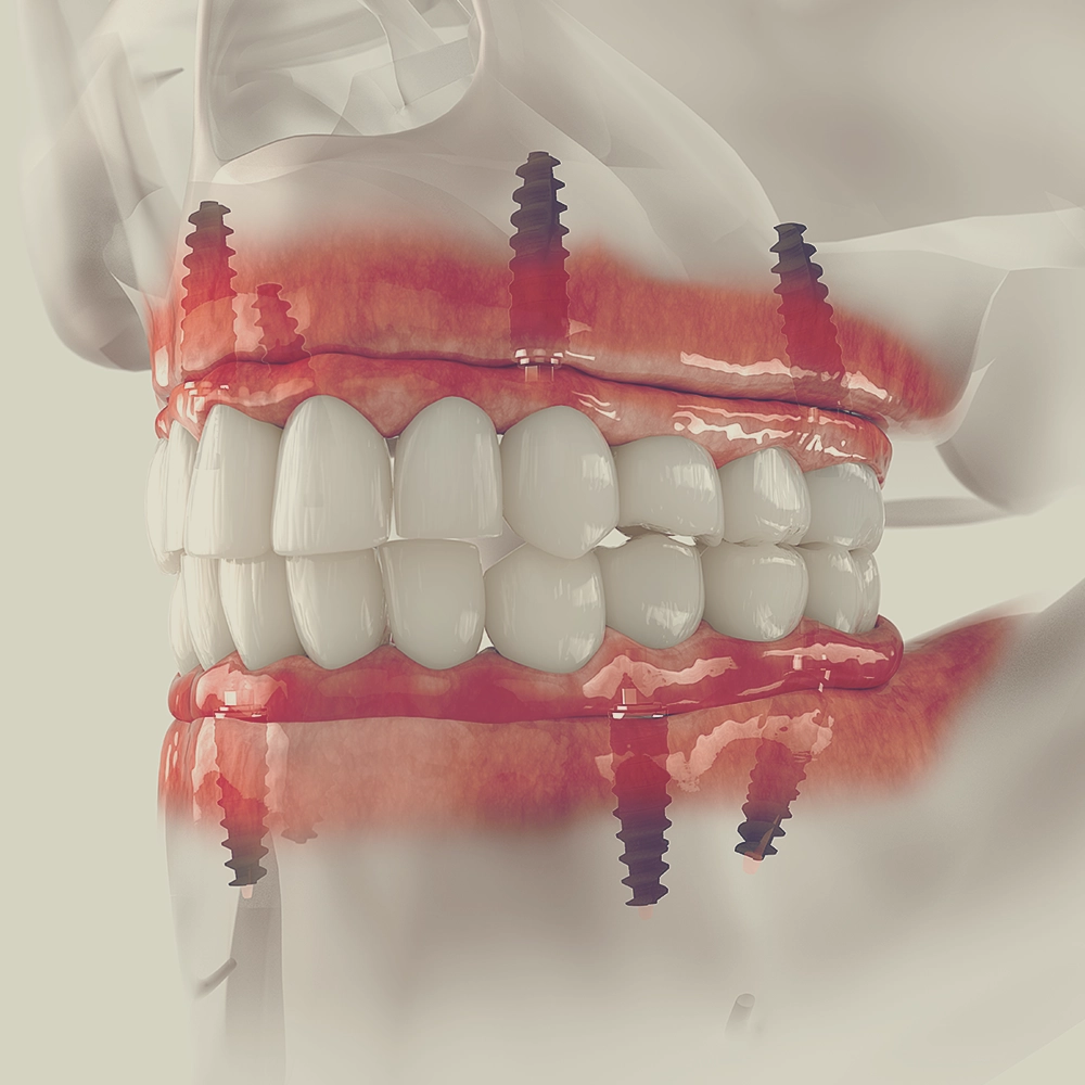 A 3D rendering showing a full set of upper and lower teeth attached to dental implants embedded in the jawbone, illustrating the structure and placement of implants for full-mouth restoration.