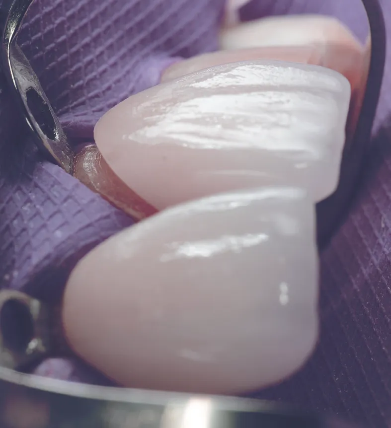 Close-up view of veneers in a dental instrument against a purple backdrop, highlighting the detailed texture and natural color of the dental prosthetics.