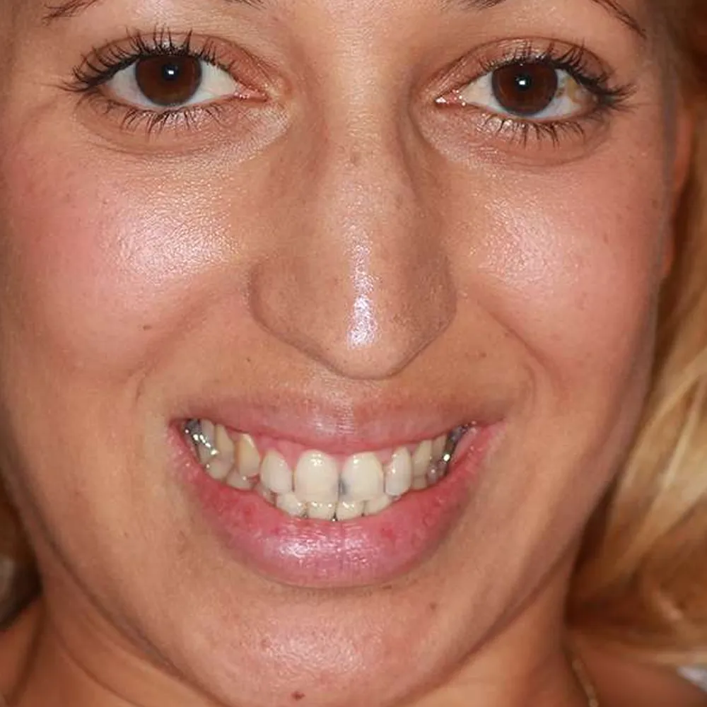 Before and after close-up images of a young woman's smile transformation using ultra-thin veneers. The first image shows her smile with natural teeth that are slightly uneven and discolored. The second image displays her smile after treatment, featuring bright, perfectly aligned white teeth that enhance her youthful appearance.